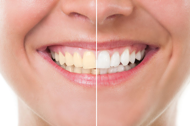 Teeth Whitening in Simi Valley